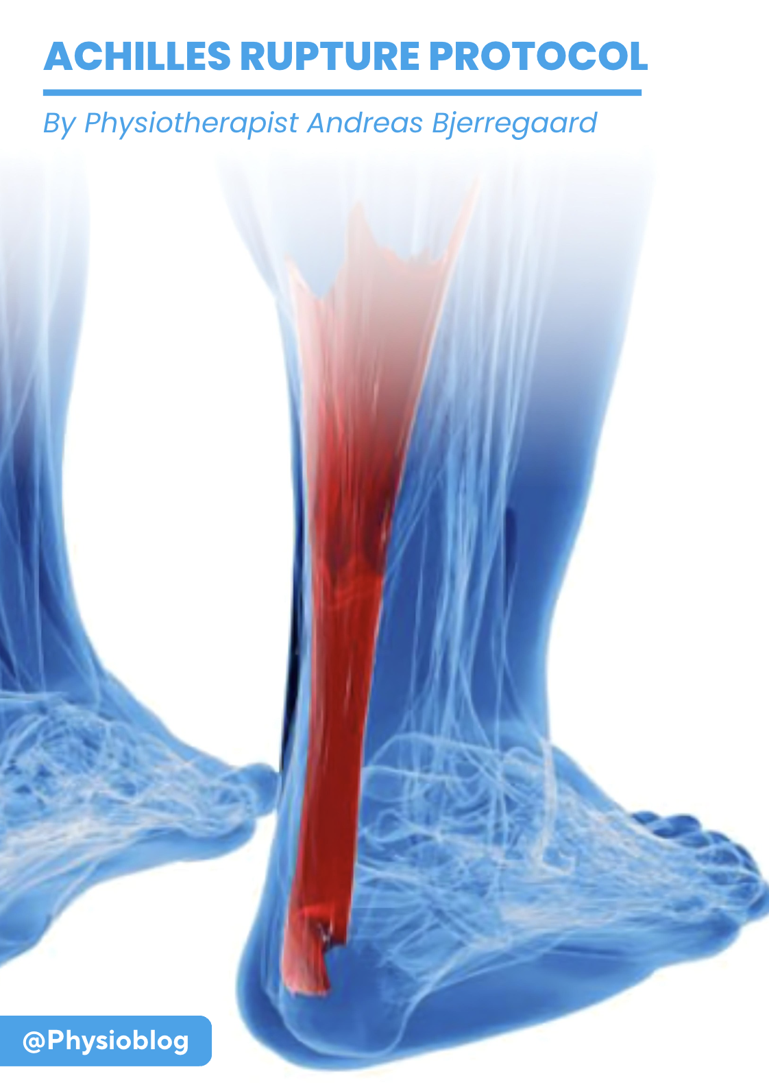 Ebook: Achilles repair protocol - Physioblog by Andreas Bjerregaard
