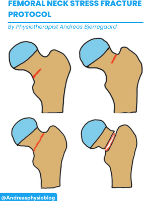 Ebook: Femoral Neck Stress fracture Protocol